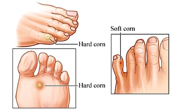 Best way to get discount rid of corns and calluses