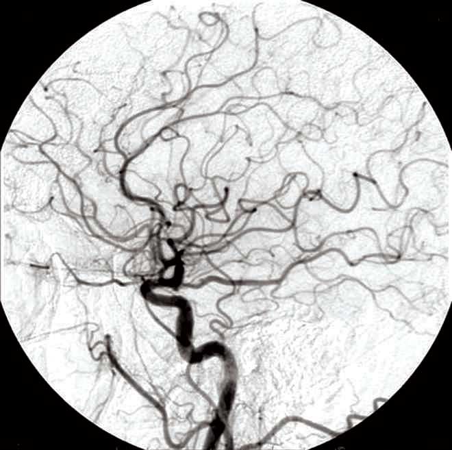 Blood vessels can be seen  in an Image obtained  by a Digital Subtraction Angiography.