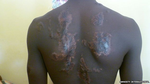   This teenage boy arrested for being a suspected militant had melted plastic poured on his back in 2013. Photo: Amnesty International 