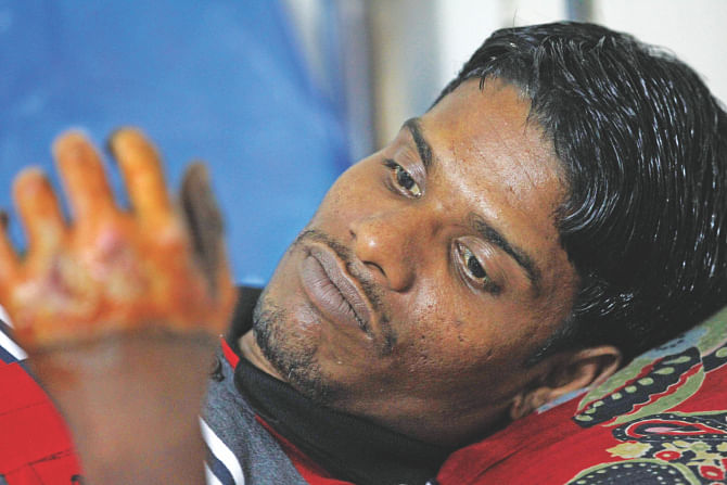 Traumatised Anwar Hossain stares at his charred hand at the burn unit of Dhaka Medical College Hospital. Arsonists attacked the auto rickshaw driver on January 23 in Chandpur. The photo was taken last week. Photo: Sk Enamul Haq 