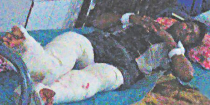 Shot in the legs by a policeman, Shah Alam having treatment at Nitor in the capital. Photo: Star