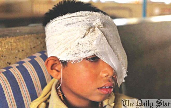 Second-grader Anik will have to live without the left eye, thanks to a crude bomb explosion in the port city's Kattali area on the election day. Photo: Anurup Kanti Das 