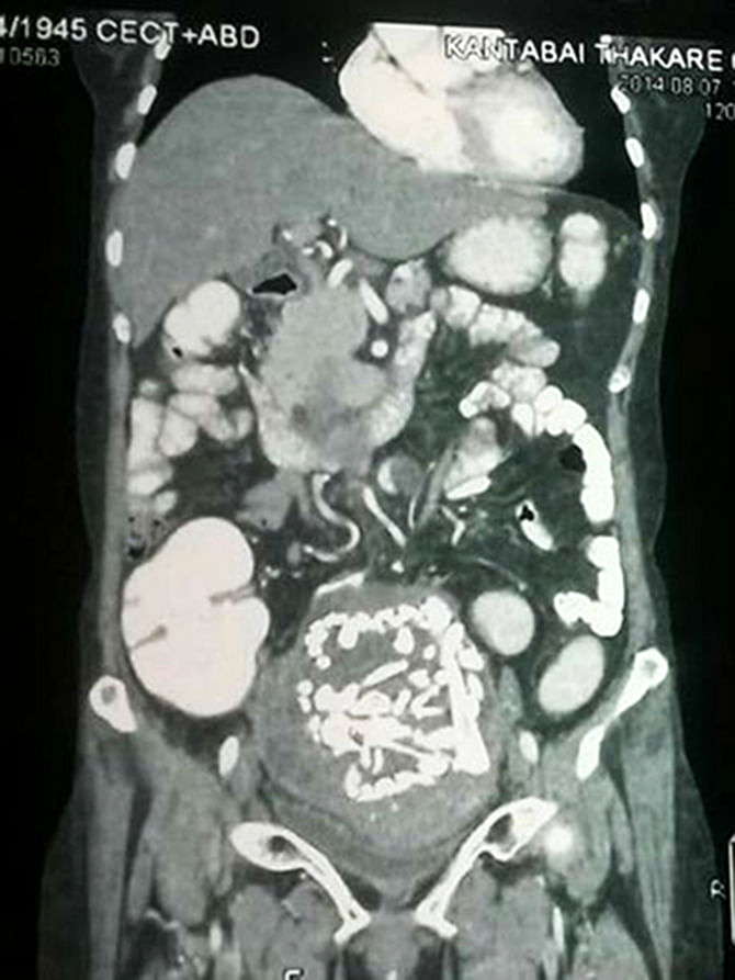 The CT scan of the mass containing the bones of a dead foetus. 