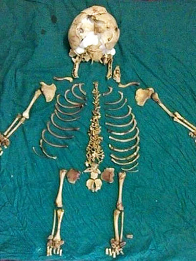 Doctors removed the skeleton believed to have come from an ectopic pregnancy in 1978. Photo: The Independent